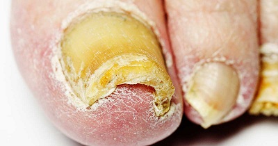 toenail fungus image 2
