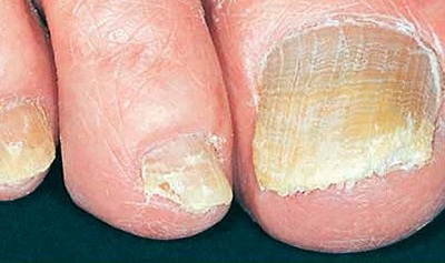 what to do for toenail fungus